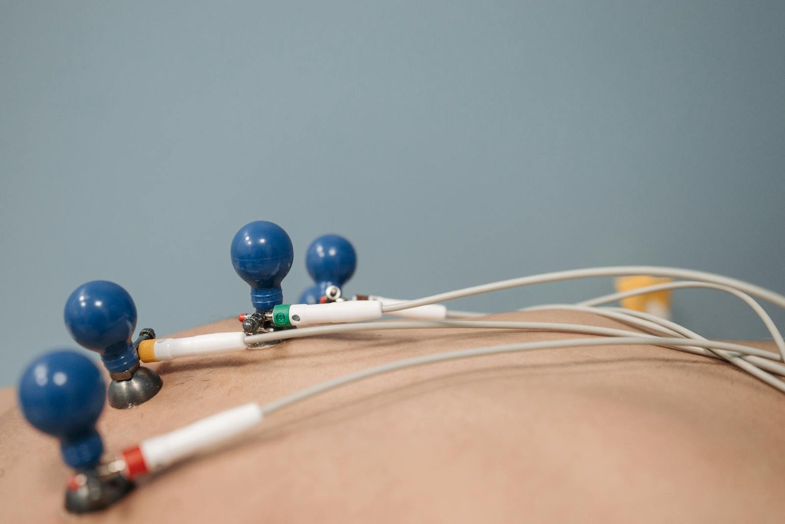 Detailed image of electrodes on a patient chest during a medical procedure